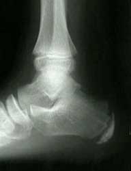 calcaneal apophysitis