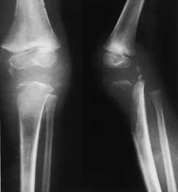 Bone Cancer Treatment