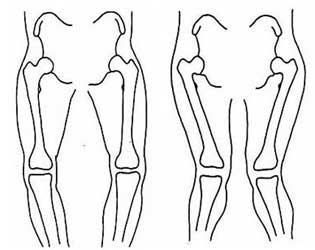 bow legs treatment