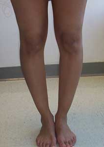 bow legs treatment