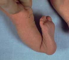 calcaneovalgus foot