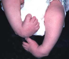 club foot