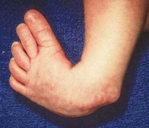 On the cure of club-foot without cutting tendons : and on certain