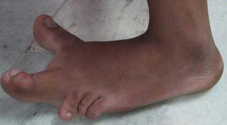 congenital deformity
