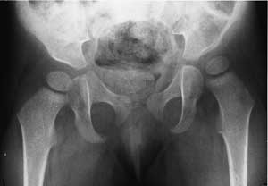dysplasia of the hip