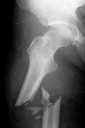 femur fracture symptoms