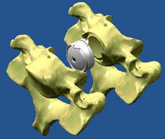 degenerative disc disease