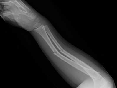 growth plate injury