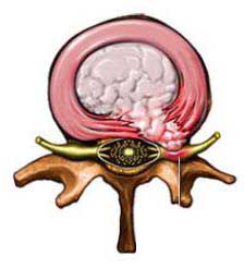 Herniated Disk