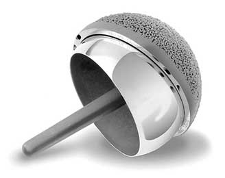 hip replacement