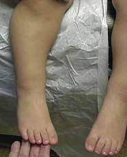 flat feet