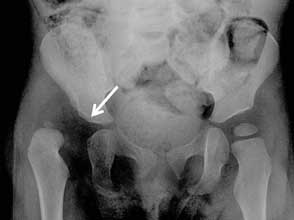 irritable hip