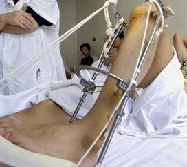 EXTERNAL LIMB LENGTHENING FOR HEIGHT INCREASE