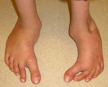 metatarsus adductus