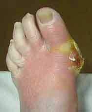 osteomyelitis