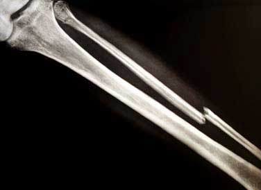 joint pain causes