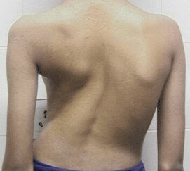 Scoliosis