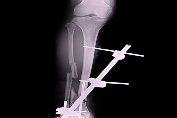 Severe-fractures-of-the-extremities