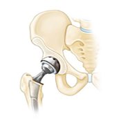 total-hip-replacement